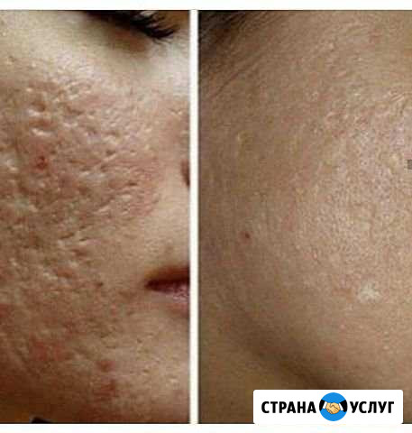 Чистка лица Кизилюрт - изображение 1