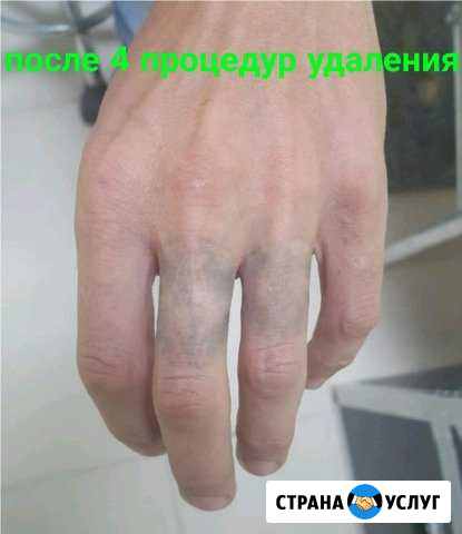 Лазерное удаление татуажа, татуировок, тату Курчатов - изображение 1