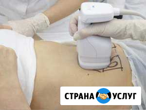 Липосоникс(липосакция лица и тела) Анапа - изображение 1