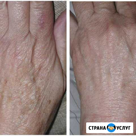 Элос омоложение Усолье-Сибирское - изображение 1
