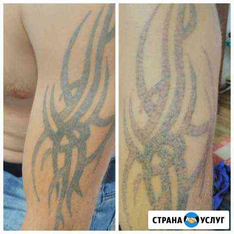 Удаление тату,татуажа,карбоновый пилинг Россошь