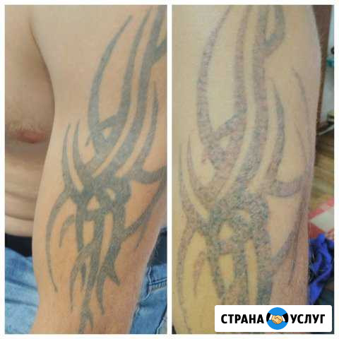 Удаление тату,татуажа,карбоновый пилинг Россошь - изображение 1