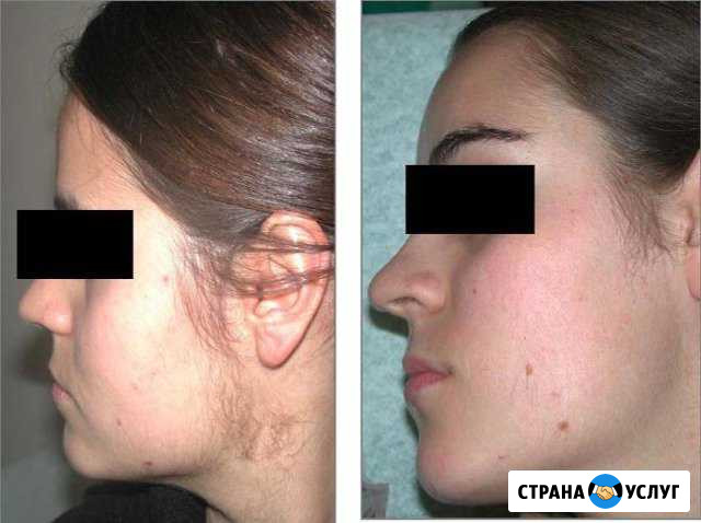 Элос-эпиляция Казань - изображение 1