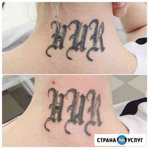 Лазерное удаление татуажа/тату Тольятти