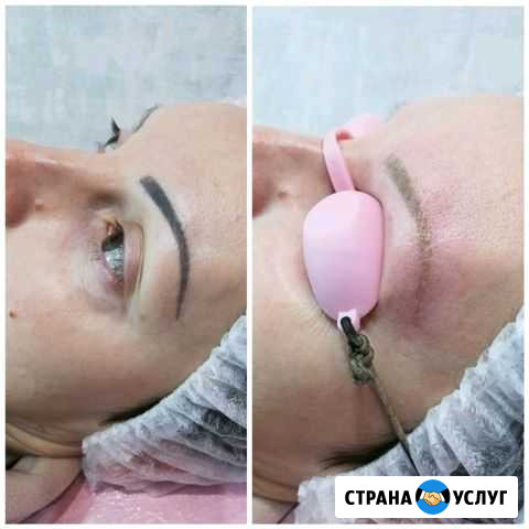 Лазерное удаление татуажа и татуировок Анапа - изображение 1