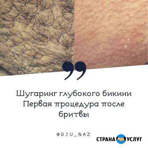 Шугаринг/Электроэпиляция Владикавказ