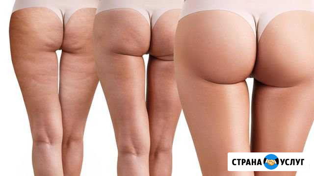Массаж антицеллюлитный Серпухов - изображение 1