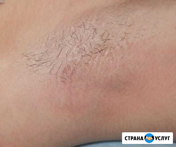Депиляция Березники - изображение 1