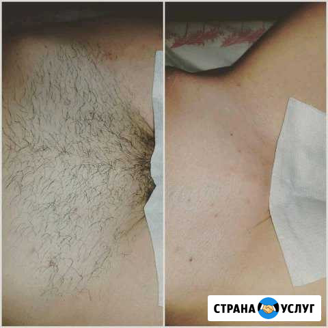 Эпиляция на дому Реутов - изображение 1