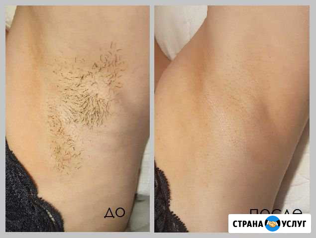 Электроэпиляция в Сарове Саров - изображение 1
