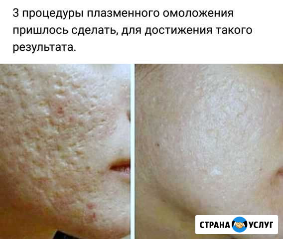 Плазменное омоложение Миасс - изображение 1