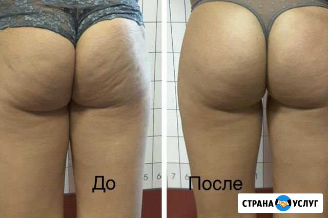 Массаж LPG Волгоград - изображение 1