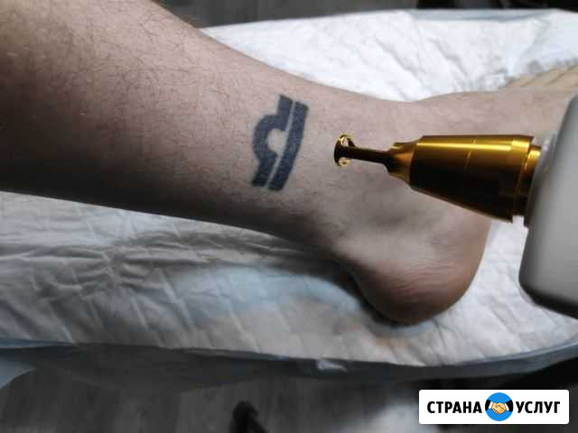 Удаление татуировок, татуажа Балашиха Балашиха - изображение 1