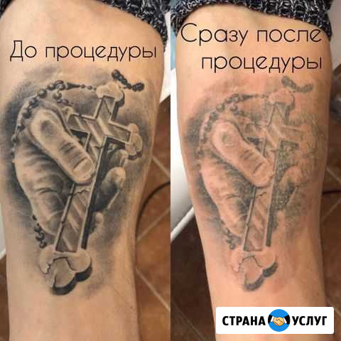 Удаление татуировки и татуаж Москва - изображение 1