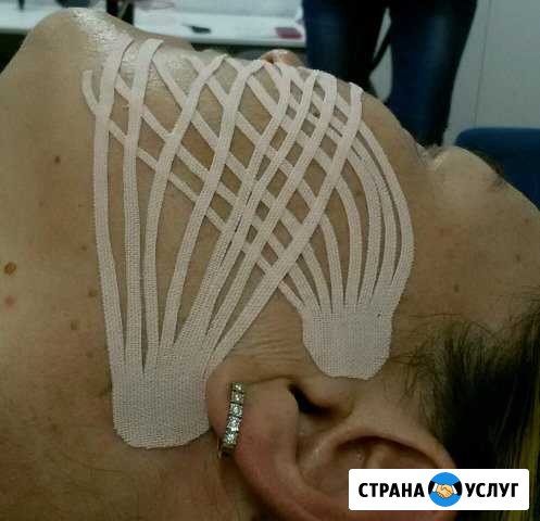 Эстетическое тейпирование лица Ижевск - изображение 1
