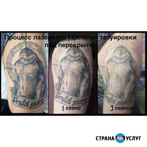 Лазерное удаление татуировок и перманента Красноярск