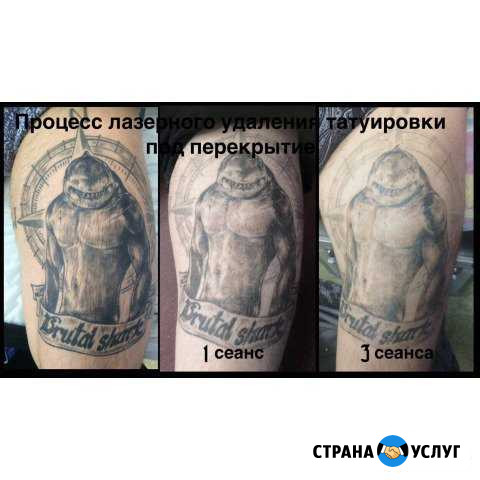Лазерное удаление татуировок и перманента Красноярск - изображение 1