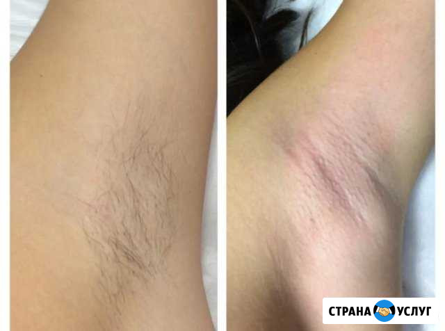 Шугаринг в Люберцах. (Возможен выезд на дом) Люберцы - изображение 1