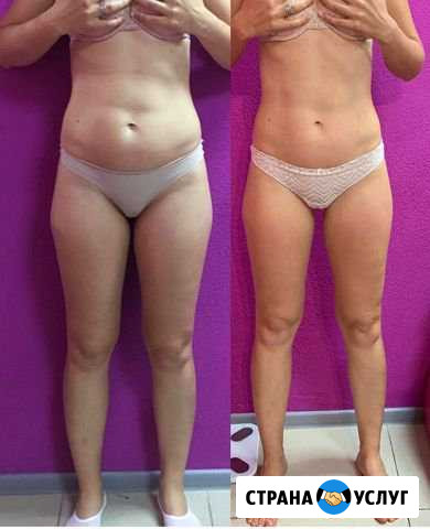 Массаж похудение Калининград - изображение 1