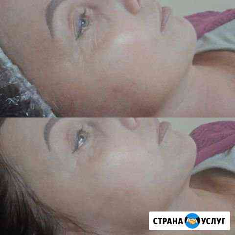 Карбоновый пилинг Дзержинск