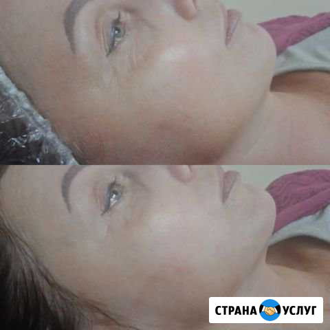 Карбоновый пилинг Дзержинск - изображение 1