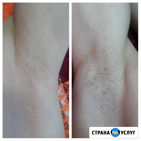 Шугаринг Шелехов - изображение 1