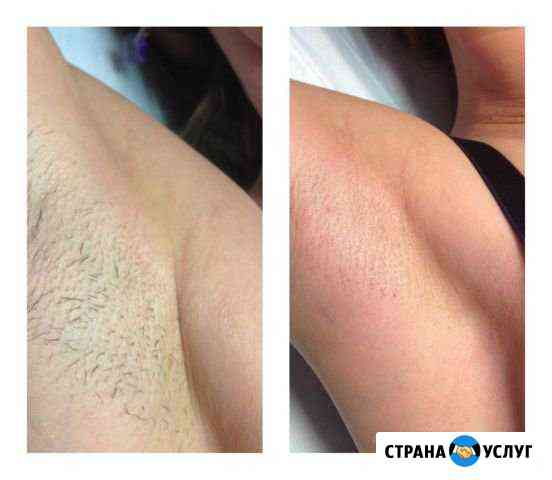 Фотоэпиляция Энгельс