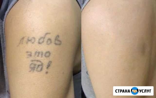 Удаление татуировок Чайковский - изображение 1