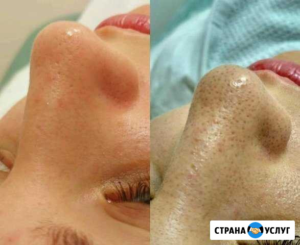 Чистое лицо Волгодонск - изображение 1