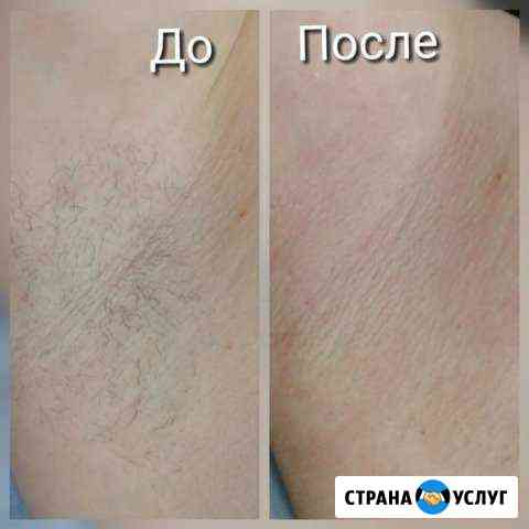 Инновационная депиляция skins Эпиляция Кстово