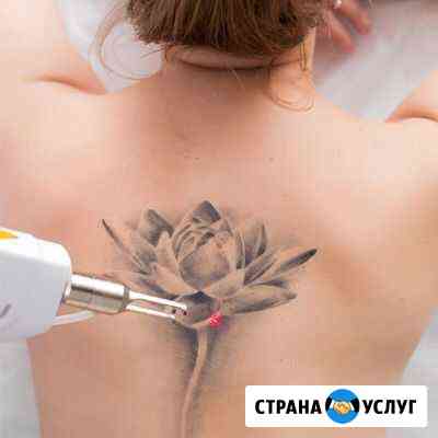 Удаление тату Кемерово