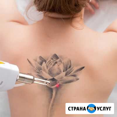 Удаление тату Кемерово - изображение 1