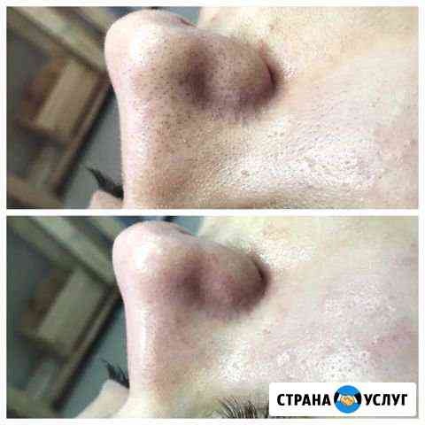 Чистка лица Нижний Тагил