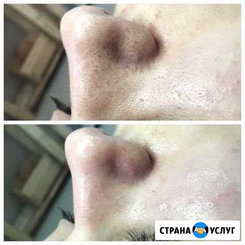 Чистка лица Нижний Тагил - изображение 1