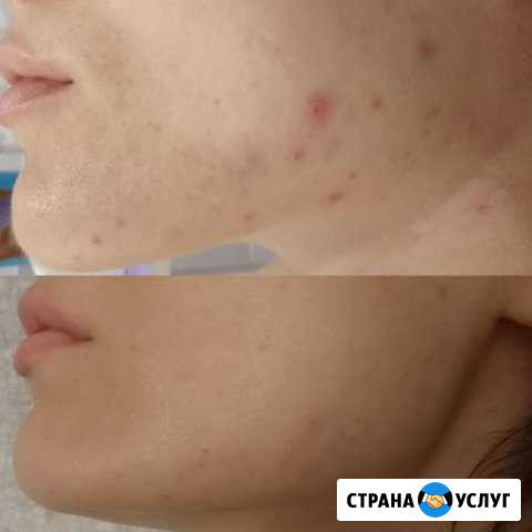 Чистка лица Новокуйбышевск - изображение 1