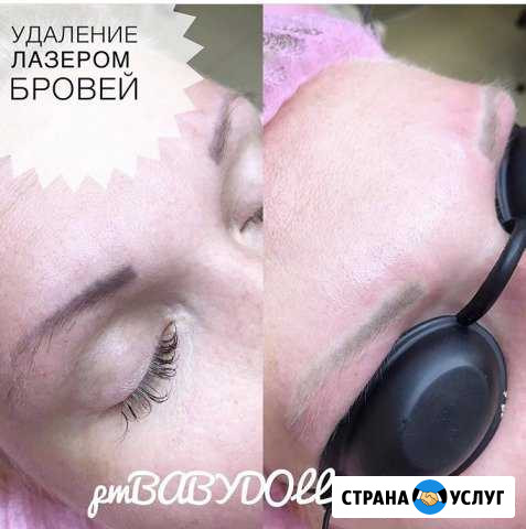 Удаление татуировок Павловский Посад - изображение 1