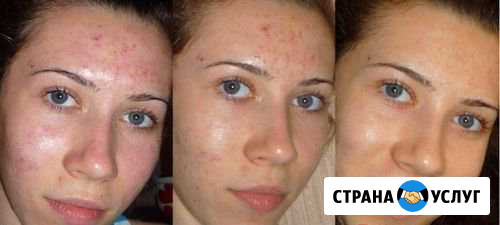 Карбоновый пилинг Кузнецк - изображение 1