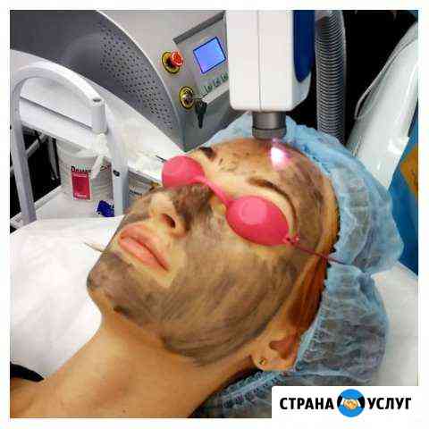 Лазерный карбоновый пилинг, голливудская чистка Анапа