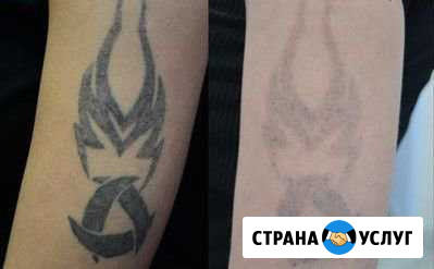 Удаление Тату и Перманентного макияжа Санкт-Петербург - изображение 1