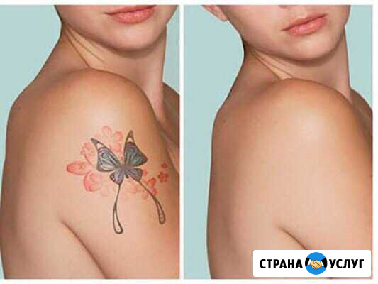 Удаление татуировок, татуажа Тобольск - изображение 1
