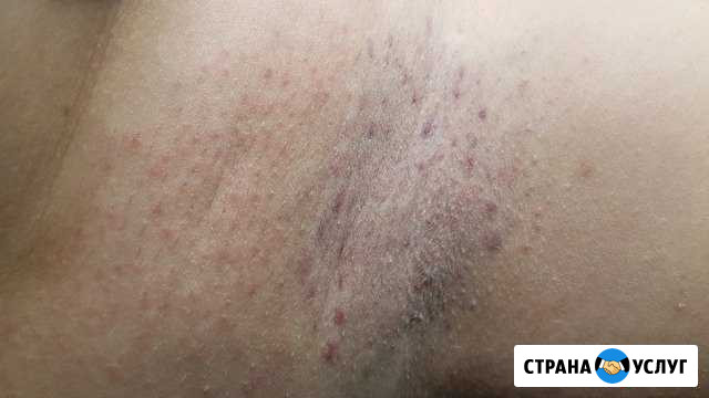Электроэпиляция Кокошкино - изображение 1