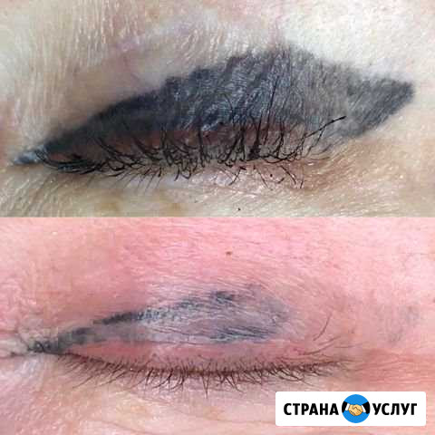 Удаление татуажа, тату, шрамов, пигментации Белгород - изображение 1