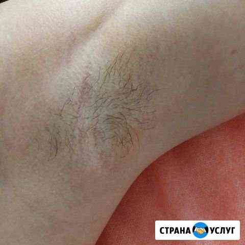 Эпиляция, шугаринг, удаление волос Александров