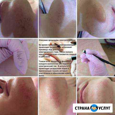 Удаление волос,папилломы, навсегда Кропоткин