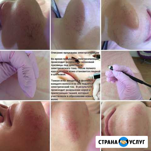 Удаление волос,папилломы, навсегда Кропоткин - изображение 1