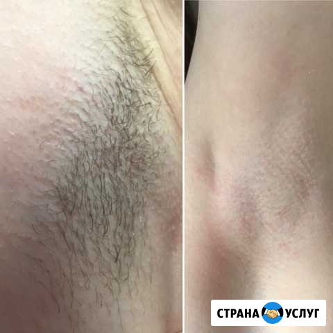 Шугаринг Пугачев - изображение 1