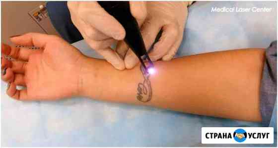 Удаление татуажа,татуировки Волгоград
