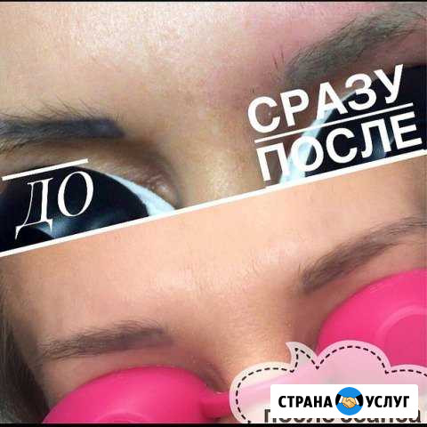 Удаление тату и татуажа лазером Сургут - изображение 1