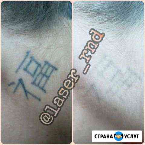 Нетравматичное удаление татуировок и татуажа Ростов-на-Дону