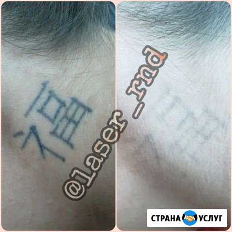 Нетравматичное удаление татуировок и татуажа Ростов-на-Дону - изображение 1